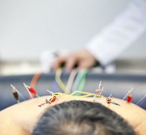 Electroacupuncture 